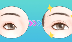上海华美做眼综合怎么样？双眼皮、开眼角、提肌风格和口碑盘点